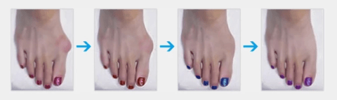 Adjustable Orthopaedic Bunion Splint Corrector